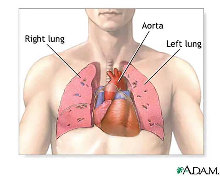 Trasplantes de corazón y pulmón con hepatitis C son seguros
