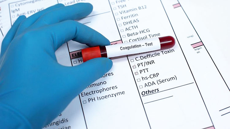 FDA desautoriza terapia genética para hemofilia